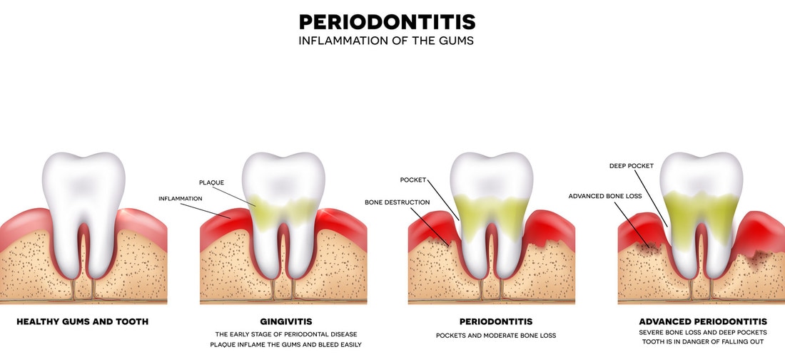 Periodontitis - Inflammation of the Gums