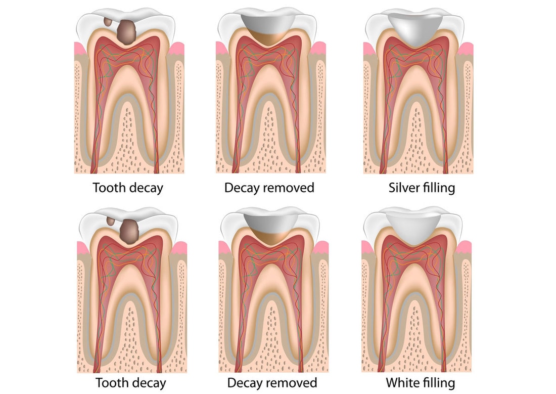 Tooth Decay Removed,  White Filling, Silver