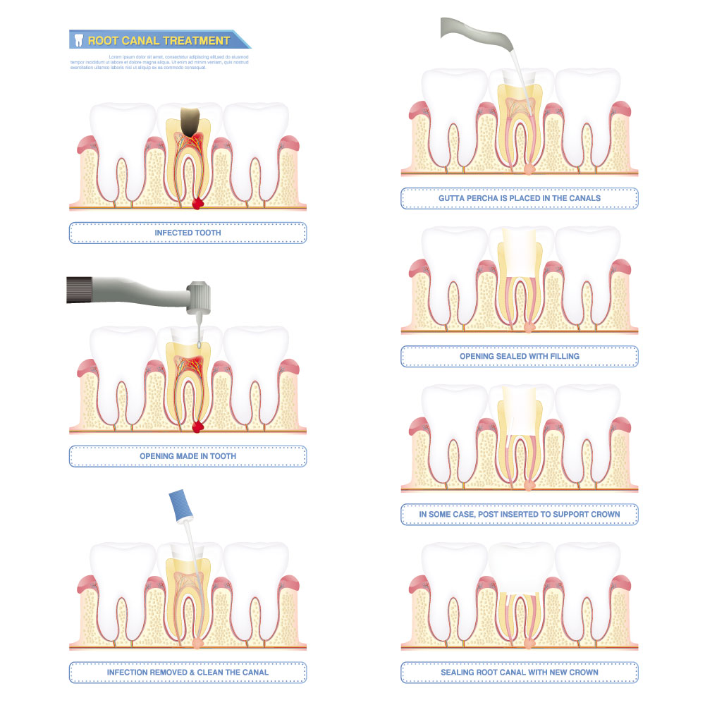 Root Canal Treatment Illustration